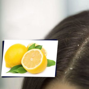 A natural remedy for dandruff - Glamorous Lady Store